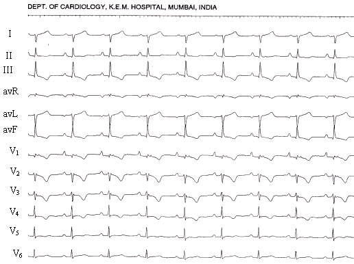 ECG Quiz 1 - KING EDWARD MEMORIAL HOSPITALKING EDWARD MEMORIAL HOSPITAL